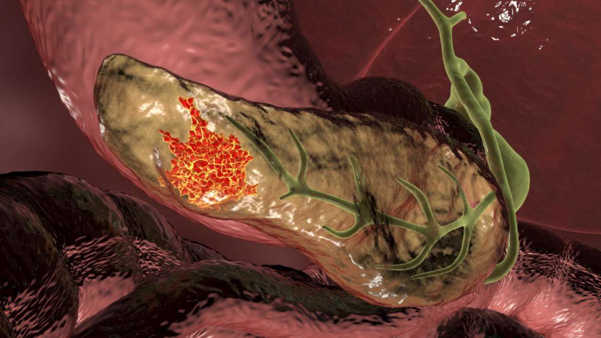 Chronic Pancreatitis