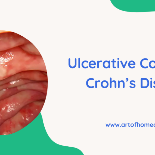 Ulcerative Colitis And Crohn’s Disease