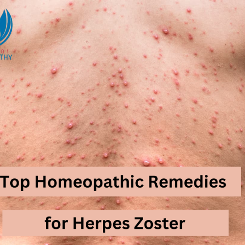 Top Homeopathic remedies for Herpes Zoster: