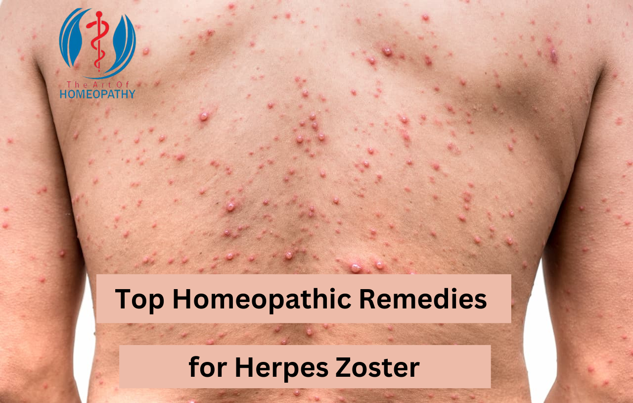 Top Homeopathic remedies for Herpes Zoster: