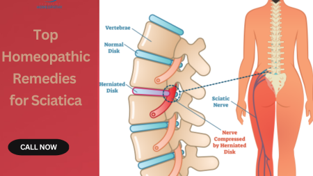 Top Homeopathic Remedies for Sciatica (1)