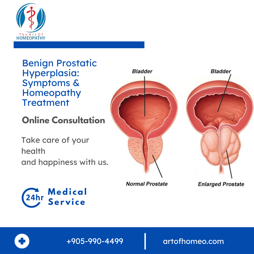 Benign Prostatic Hyperplasia Symptoms & Homeopathy Treatment