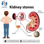 Every Thing About Kidney Stones