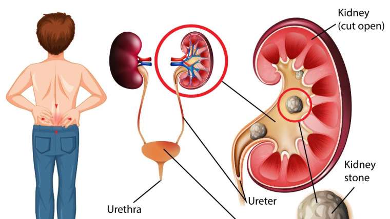 Kidney Stones