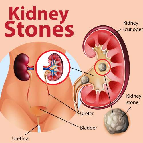 Homeopathy for Kidney Stones
