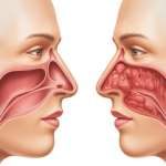 Seasonal Sinusitis vs. Chronic Rhinitis: Choosing the Right Homeopathic Path